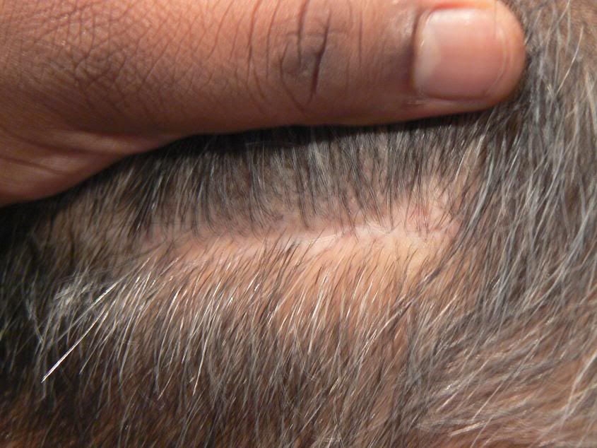 What Is The Difference Between Staples And Stitches